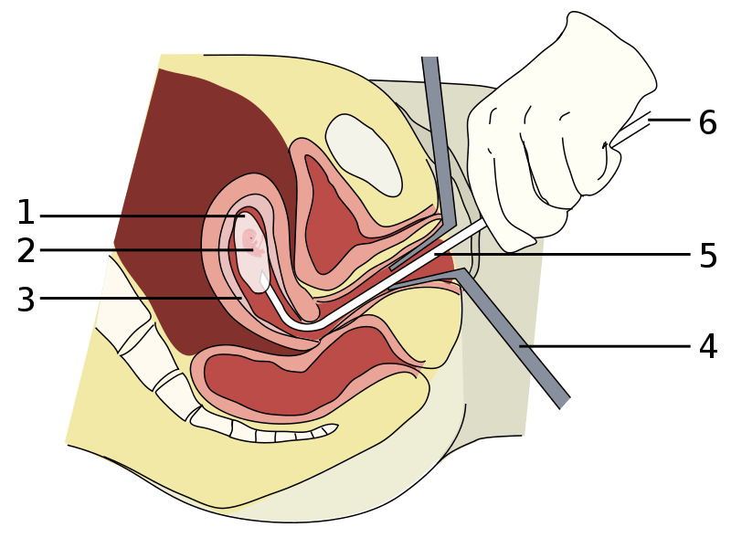 真空吸引法。在此法問世之前，子宮刮搔術是墮胎的主要方法。